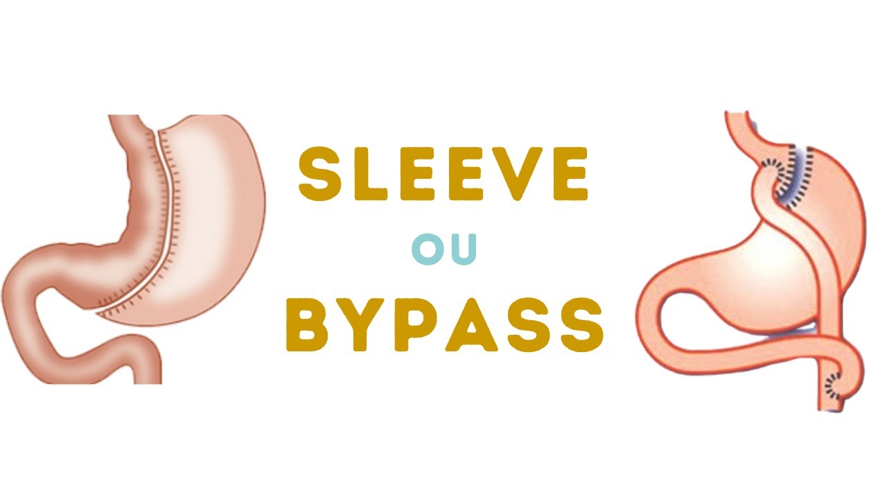 Chirurgie obésité Sleeve ou bypass Que choisir