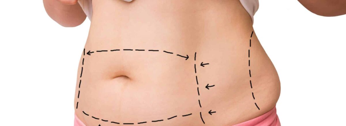 abdominoplastie tunisie