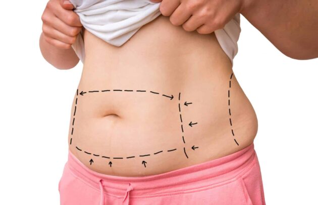 abdominoplastie tunisie