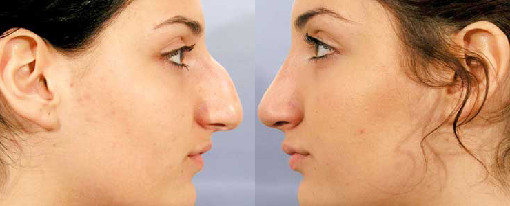 rhinoplastie avant apres