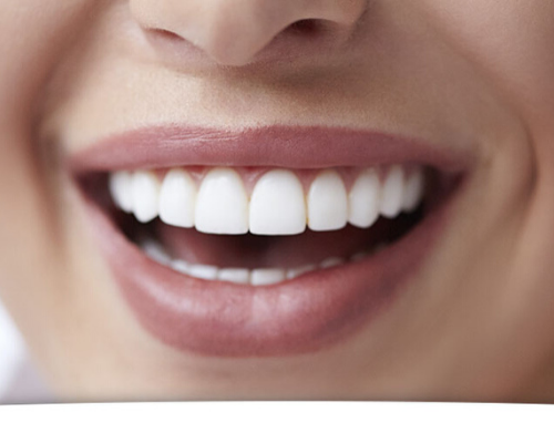 Blanchiment des dents : le peroxyde d'hydrogène placé sous surveillance