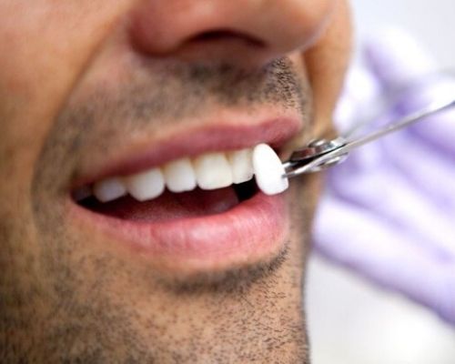 Facette dentaire Tunisie : Prix des facettes dentaires pas cher