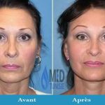 lifting visage avant apres