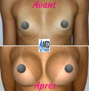 chirurgie seins avant apres