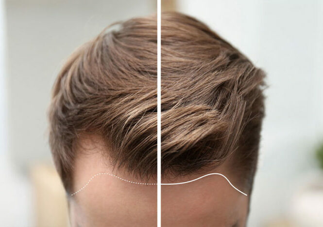 La greffe de cheveux chez les stars