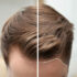 La greffe de cheveux chez les stars