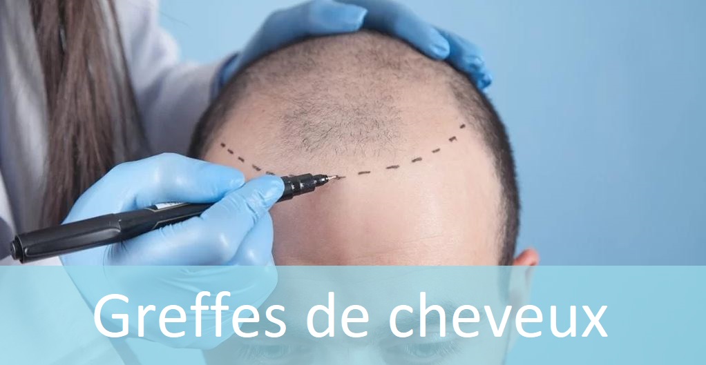 greffes de cheveux